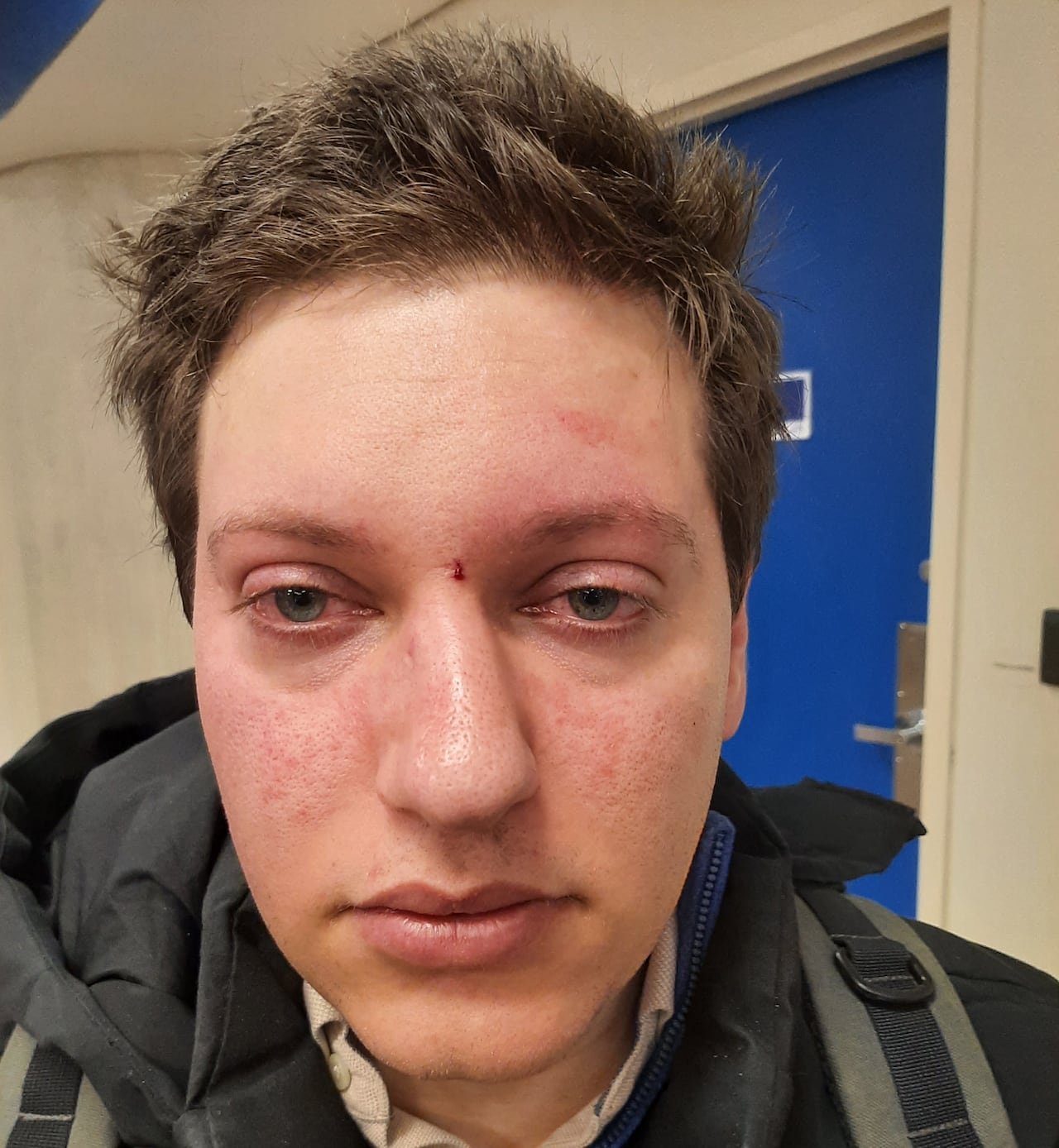 A man with injuries to his face takes a photo.